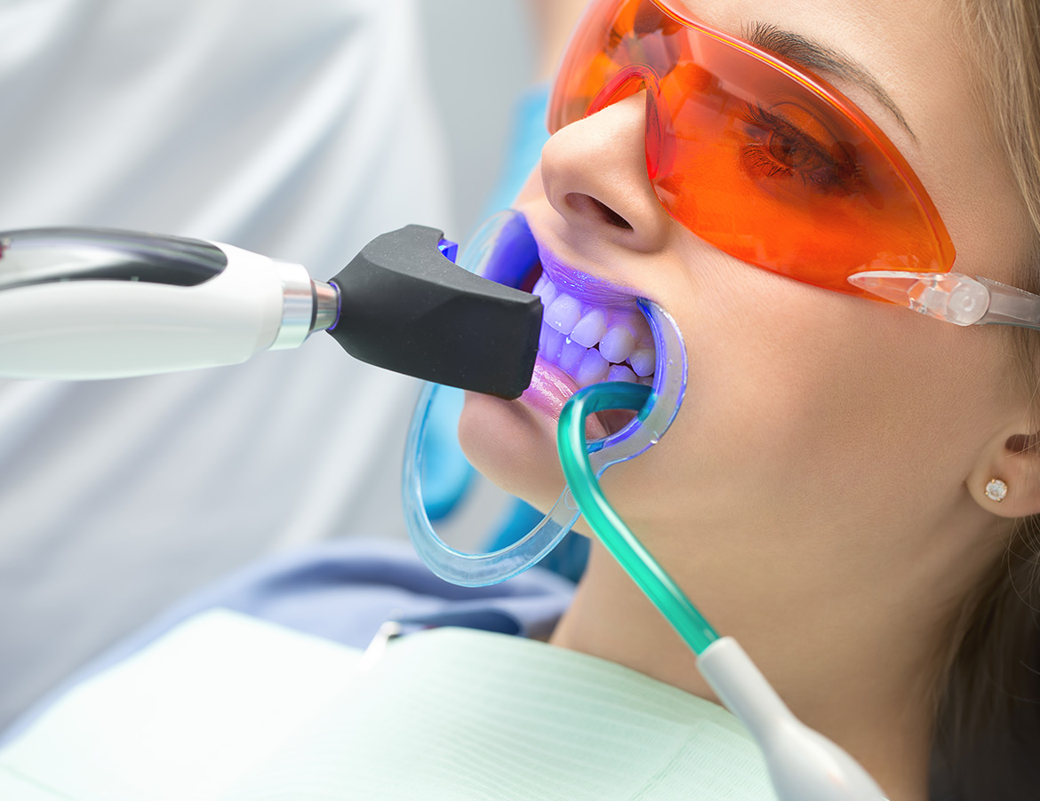 Blanqueamiento Dental